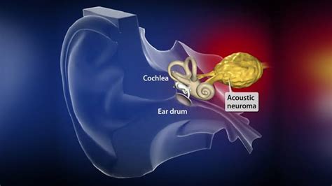 Acoustic Neuroma | Symptoms, Causes & Complications | Santripty