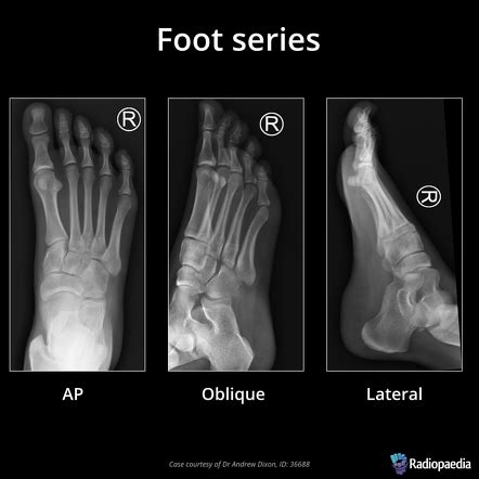 Foot series | Radiology Reference Article | Radiopaedia.org