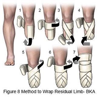 Pin by Chan_1990 on Beyond light_v2 | Below the knee amputation, Orthotics and prosthetics ...