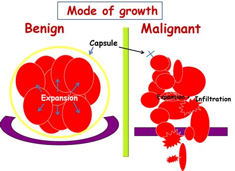 Benign Tumor Vs Malignant Tumor : Know the Fact - Indo 2 Africa Medical Tourism Guide