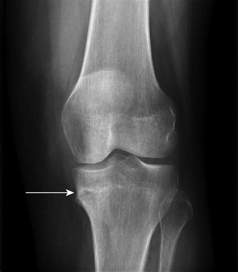 Fractures of the Proximal Tibia Associated with Longterm Use of ...