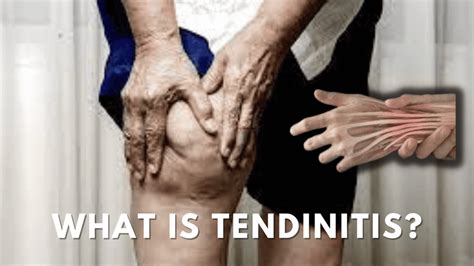 Tendinitis (tendonitis): Types, Symptoms, Causes, And, 59% OFF