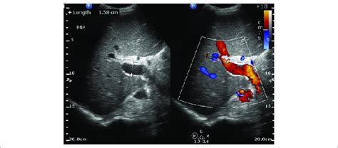 Portal Vein Measurement Ultrasound