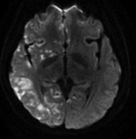 Brain MRI showing paradoxical CO 2 embolism. The diffusionweighted... | Download Scientific Diagram