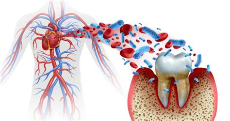 What Is Periodontal Scaling And Root planning? | Serene Dental Center