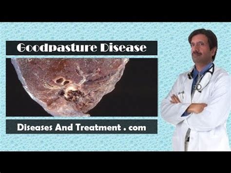 Goodpasture syndrome : Causes, Diagnosis, Symptoms, Treatment, Prognosis - YouTube