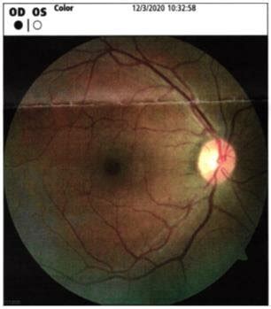 Fundus image of the right eye | Download Scientific Diagram