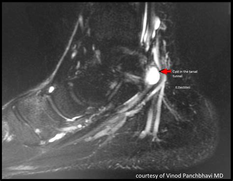 Tarsal Tunnel Syndrome - FootEducation