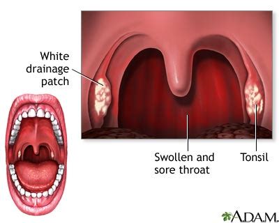 Swollen Lymph Nodes In Throat