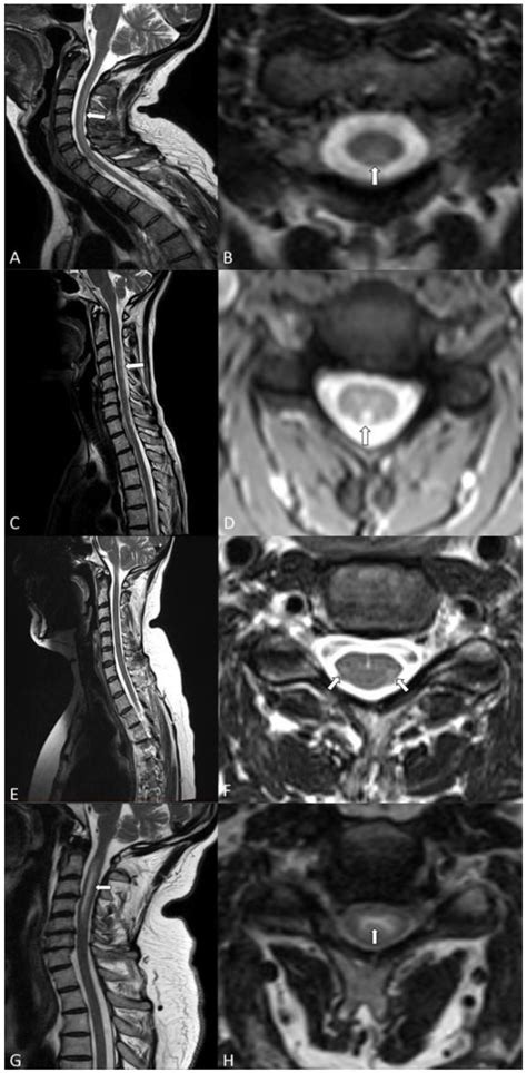 Cervical spinal cord MRI of all patients, with sagittal (left) and ...