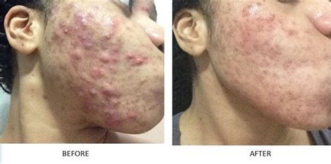 Before & After Acne Treatment Photos | Natural Acne Clinic