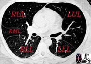 000 Fissures of the Lung | Lungs