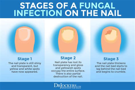 Fungal Nail Infection Know The Causes Symptoms Of It! By Niraj Jain Lybrate | atelier-yuwa.ciao.jp