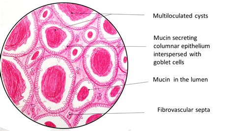 Mucinous Cystadenoma- Ovary - Pathology Made Simple