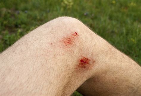 Signs and Symptoms of Infection in a Scrape | Livestrong.com