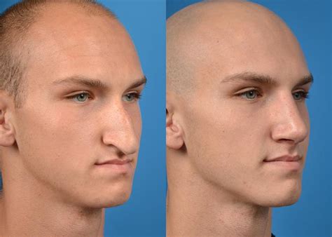 Male Rhinoplasty | Melbourne, FL | Patient 11244