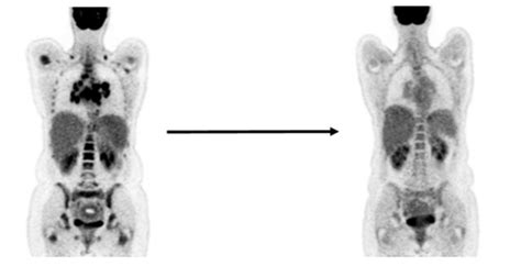 High-tech scans spare lymphoma patients intensive chemo | Cancer Research UK