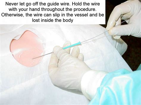 Clinical Notes: Central Line Placement: A Step-by-Step Procedure Guide with Photos