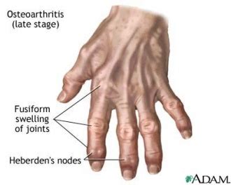 Wrist and Hand Osteoarthritis - Physiopedia