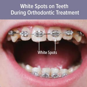 What To Do About White Spots on Teeth After Wearing Braces