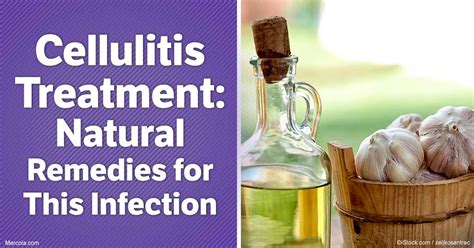 Try These Natural Alternatives for Cellulitis Treatment