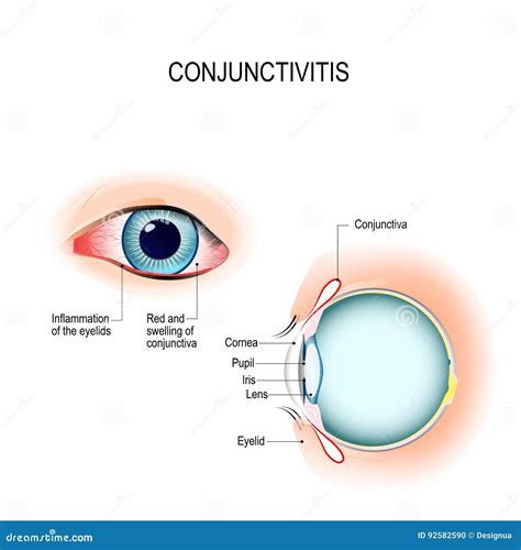 Conjunctivitis. External View and Vertical Section of the Human Stock Vector - Illustration of ...