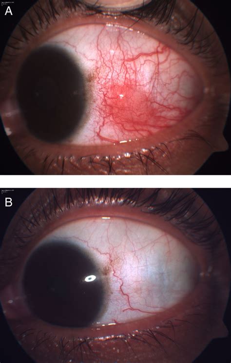 Phlyctenular conjunctivitis: a rare association with spinal intramedullary tuberculoma | BMJ ...