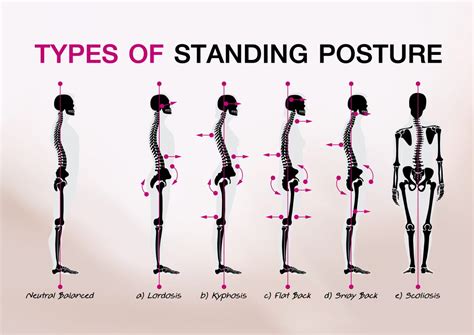 Is your posture hurting you? - Body Fit Solutions