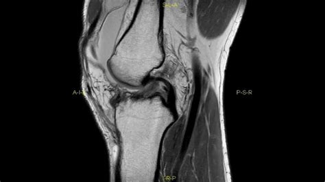 Lateral Tibial Plateau Stress Fracture