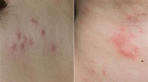 Bed Bugs vs. Hives: How to Tell If It’s Just a Bite or an Allergic Reaction