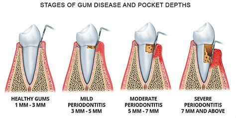 Treatment of Periodontitis - ViardenLab