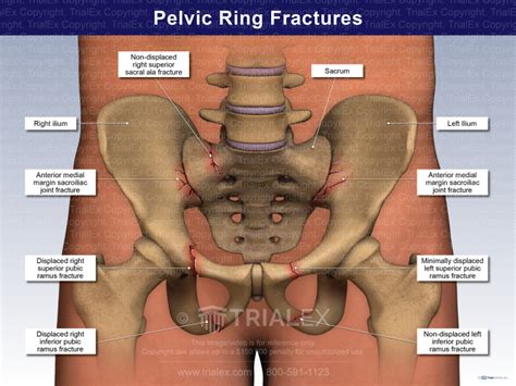 Bone fracture pelvic - sherymob