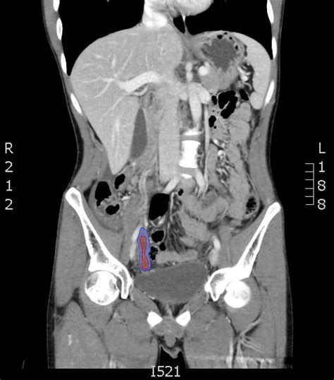 CT Diagnosis of Appendicitis - JETem