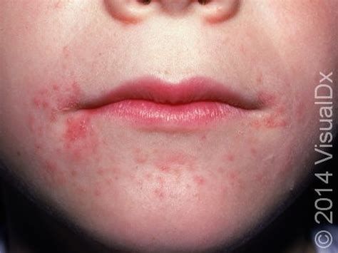 Contact Dermatitis Mouth