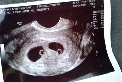 Twin pic ultrasounds | BabyCenter