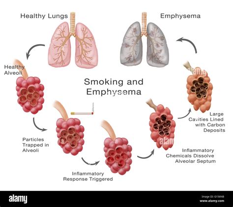 Tuberculosis Lungs Vs Healthy Lungs