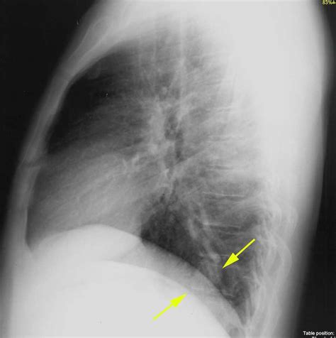 Pulmonary AVM on Chest X-ray - X Rays Case Studies - CTisus CT Scanning