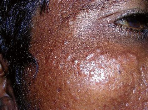 Skin-colored papules on the face - Indian Journal of Dermatology, Venereology and Leprology