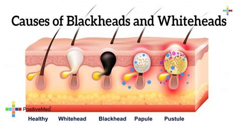 Causes of Blackheads and Whiteheads