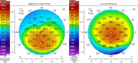 Keratoconus Myths Busted- 6 Most Common Misconceptions