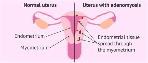 Adenomyosis - KloeShivek