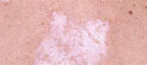 What are common causes for spots on the skin? - proquestyamaha.web.fc2.com