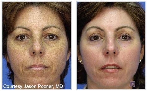 Liver spots and hyperpigmentation treatment in tucson | Proskin Clinics