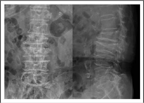 Figure 1 from Comparison of sacroplasty with or without balloon assistance for the treatment of ...