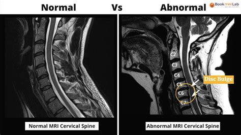 Normal Vs Abnormal Mri Cervical Spine