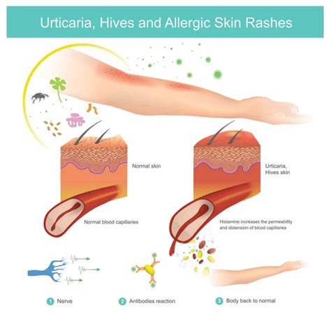 Vectores de stock de Urticaria, ilustraciones de Urticaria sin royalties | Depositphotos®