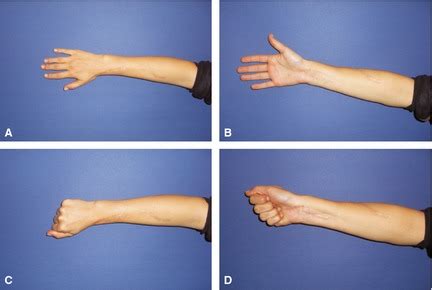 14 months after bony reconstruction, patient showed full range of... | Download Scientific Diagram