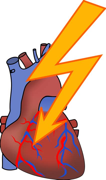 Download Arrhythmia, Heart Attack, Cardiac. Royalty-Free Vector Graphic ...