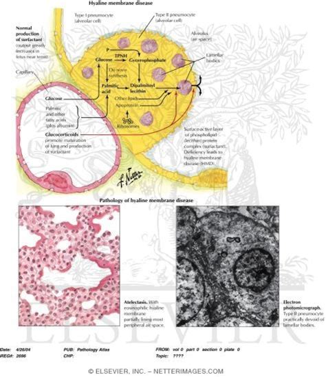 Hyaline Membrane Disease