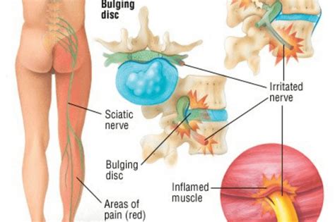 Nerve Pain In The Leg – Causes, Symptoms, Treatment, Exercise